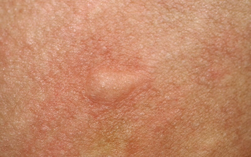 Close up of minor skin irritation caused by a bug bite.