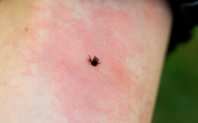 Close up of a tick embedded in skin, with a rash surrounding the bite.