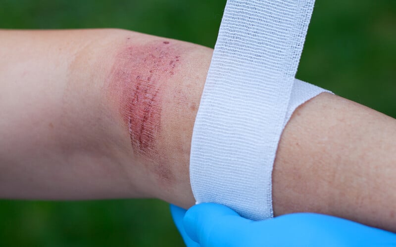 Close up of a burn wound on an elbow being wrapped with gauze.